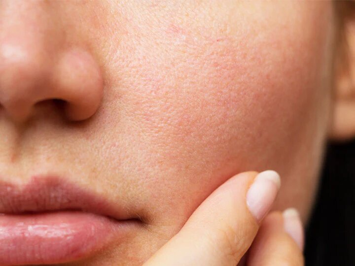 Intuitive Steps for Overcoming Open Pores